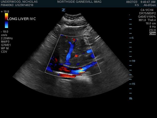 2023 Abdomen Ultrasound.SER00001.I00013.jpg